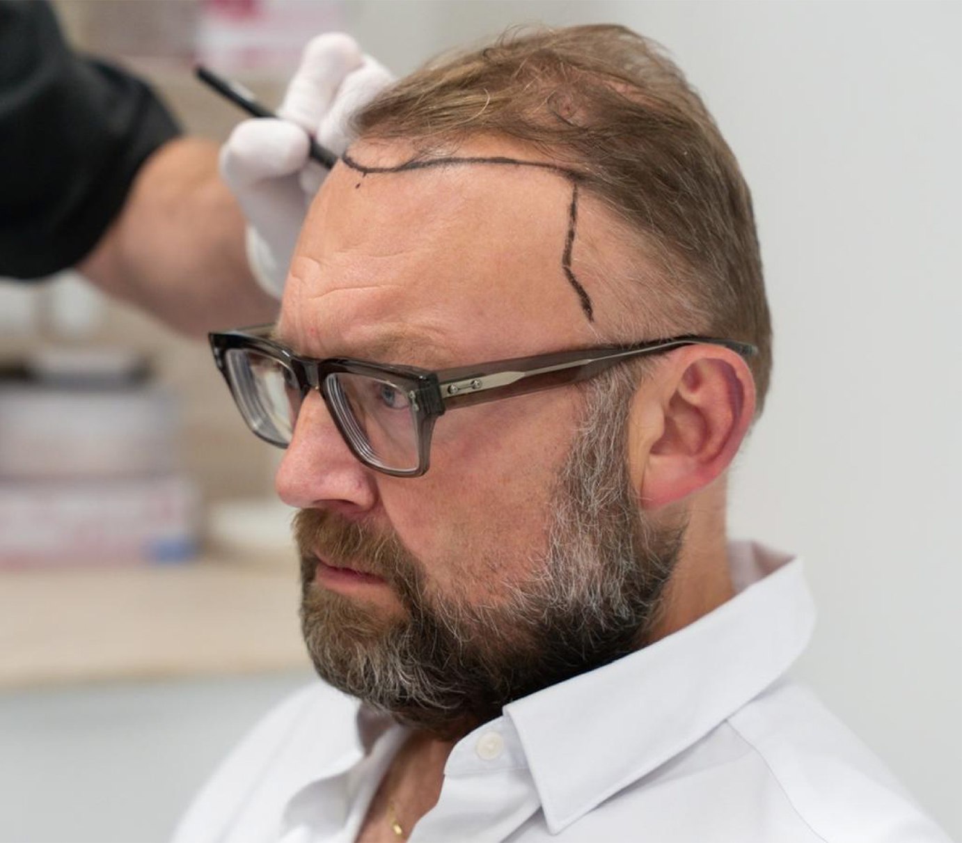 Transplantace vlasů — LM Clinic